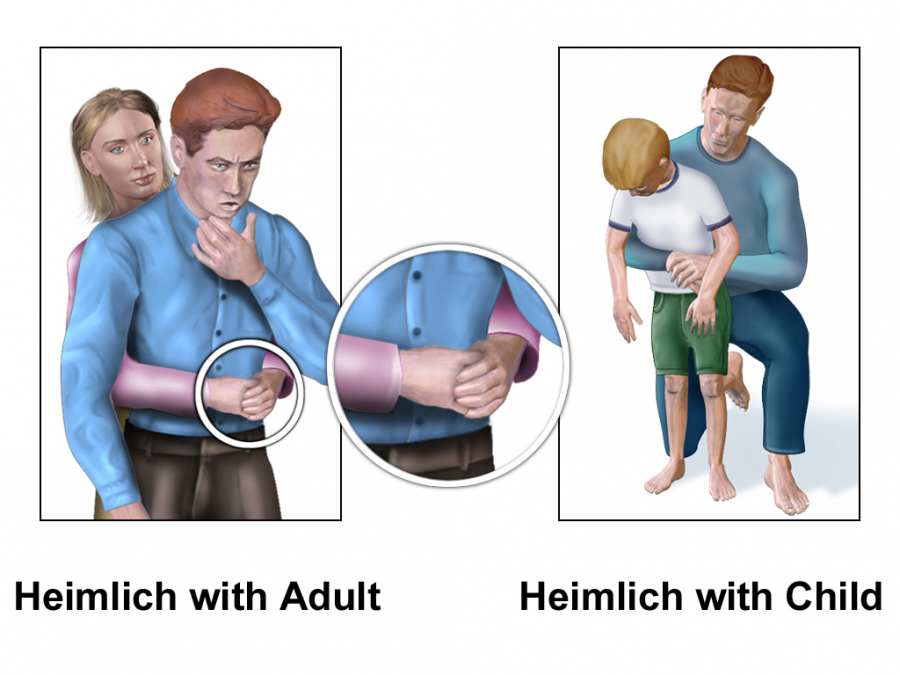 How the Heimlich Maneuver Saved a Students Life